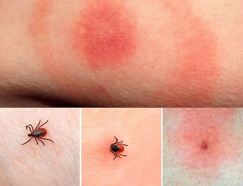 Хвороба Лайма Фото з відкритих джерел