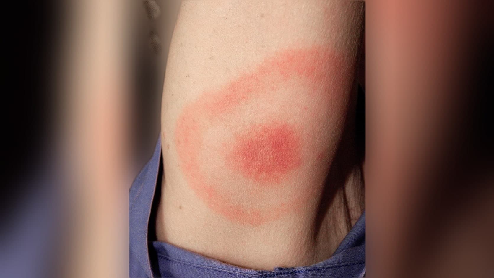 Ілюстративне фото. Ознака хвороби Лайма на шкірі